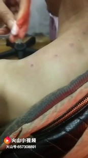 这个病人肩周炎，做了经络微创好