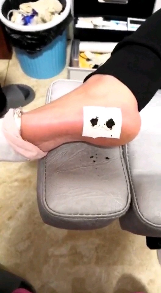 跖疣当鸡眼治传染了